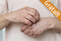 Actualització Terapèutica en Dermatitis Atòpica