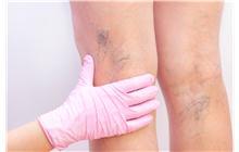 Exploració clínica ecogràfica de la Trombosi Venosa Profunda a extremitats inferiors i superiors